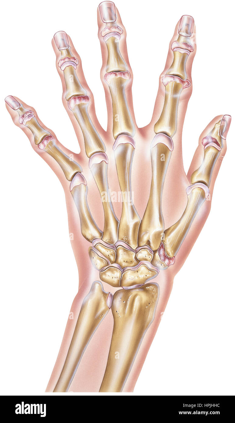 Shown is a hand with moderate arthritis of some of the joints, This