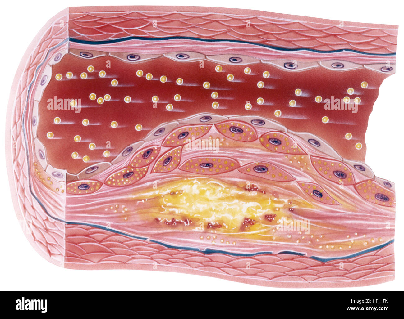 Vascular atherosclerosis showing a cutaway view of accumulated plaque in an afflicted blood vessel. This condition is entirely avoidable and reversabl Stock Photo