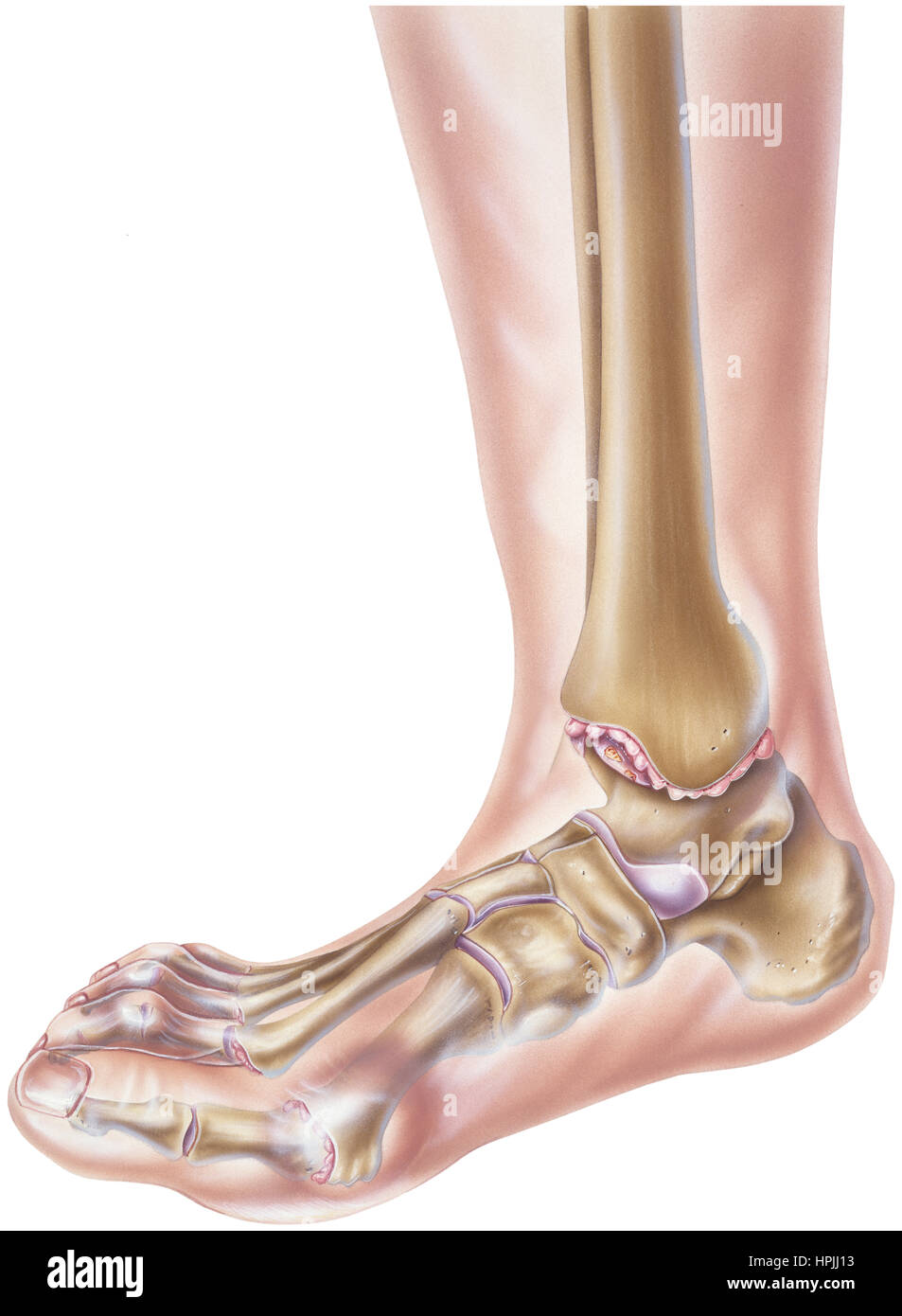 Osteoarthritis ankle hires stock photography and images Alamy