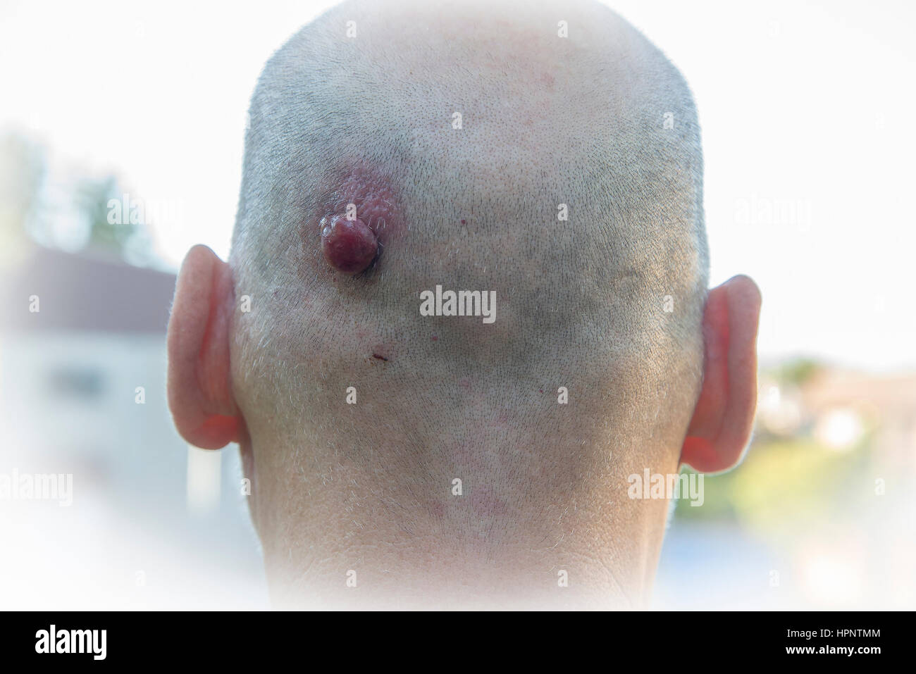 Pyogenic granuloma skin growth on mans head Stock Photo