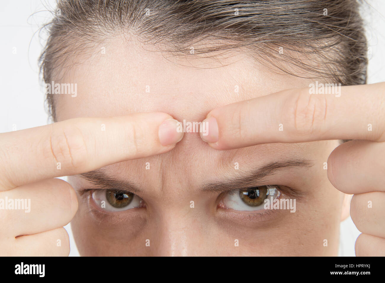 Young girl with problem skin  acne on the face close up Stock Photo