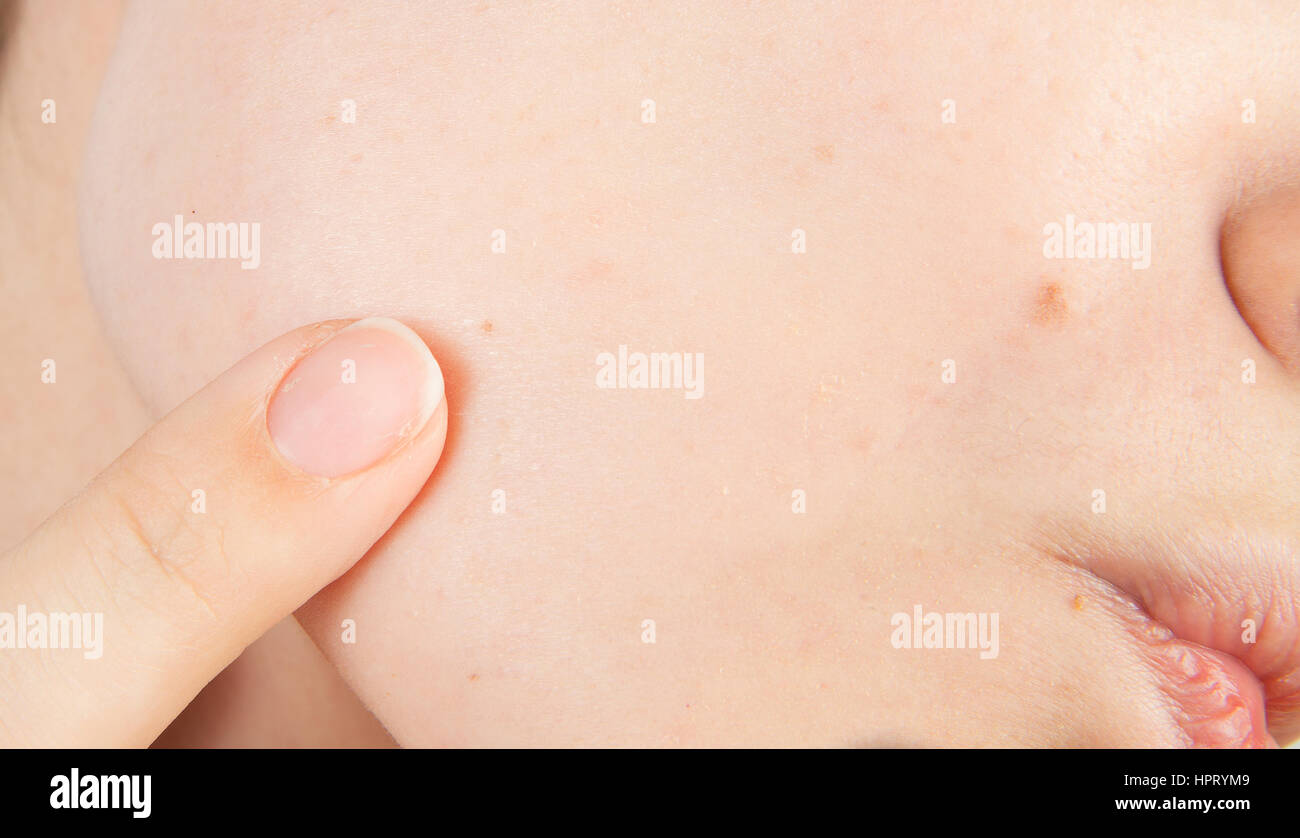 Young girl with problem skin acne on the face Stock Photo