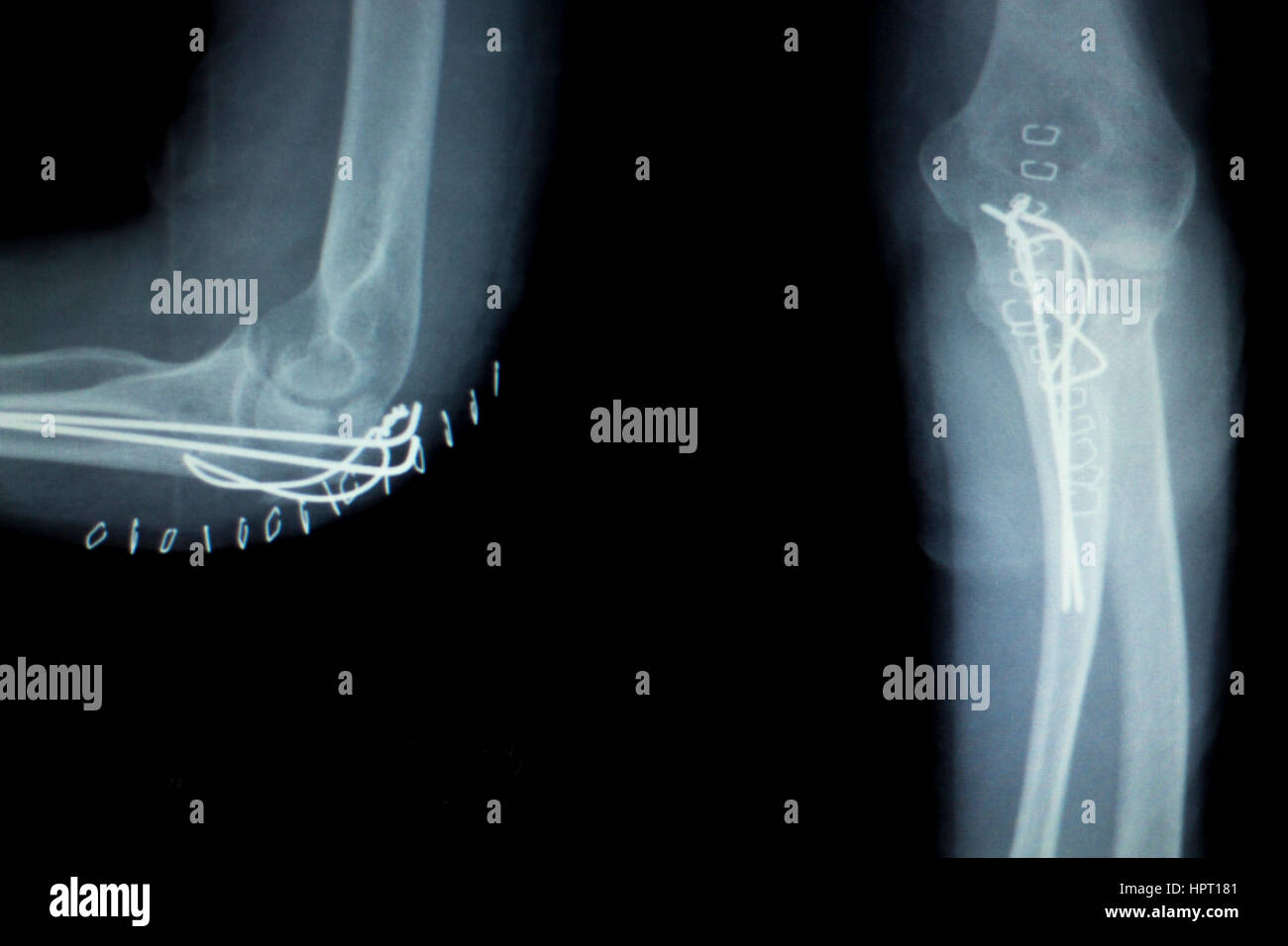 Elbow Arm Forearm Orthopedic Titanium High Resolution Stock Photography