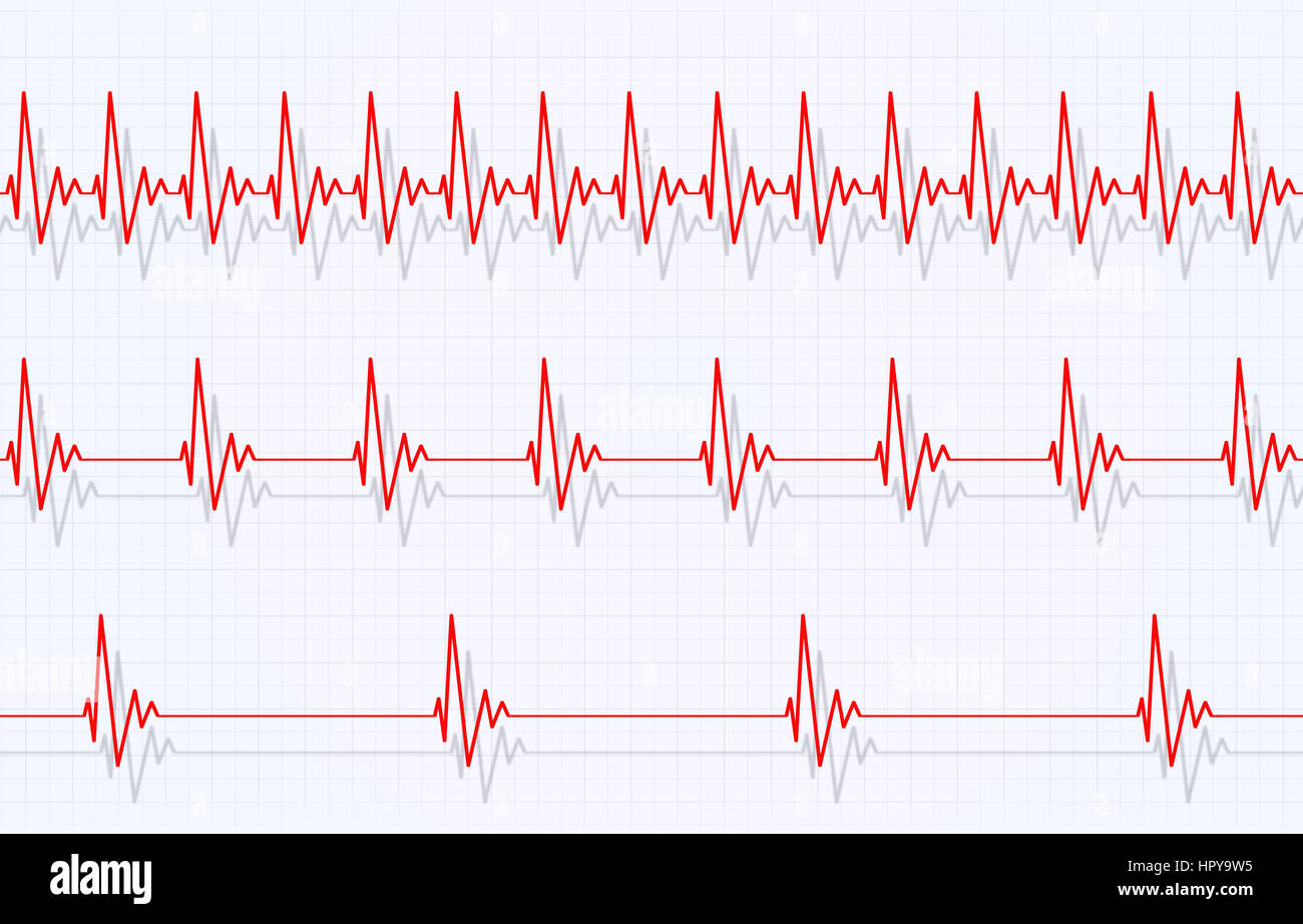 fast heartbeat clipart