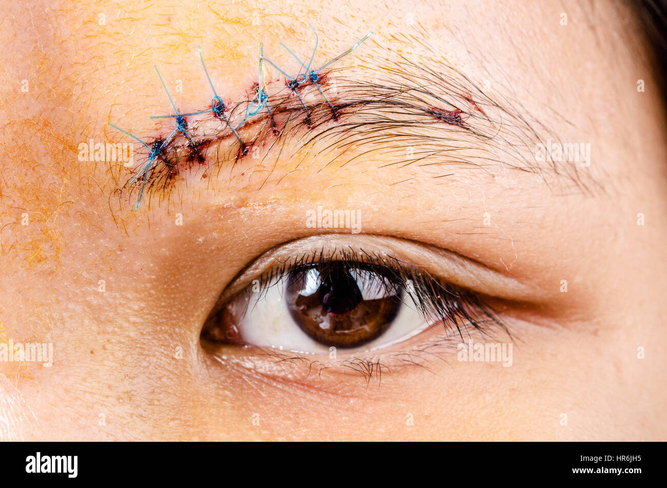 scar form stitched up skin after an operation with a blue fiber at eyebrow area Stock Photo