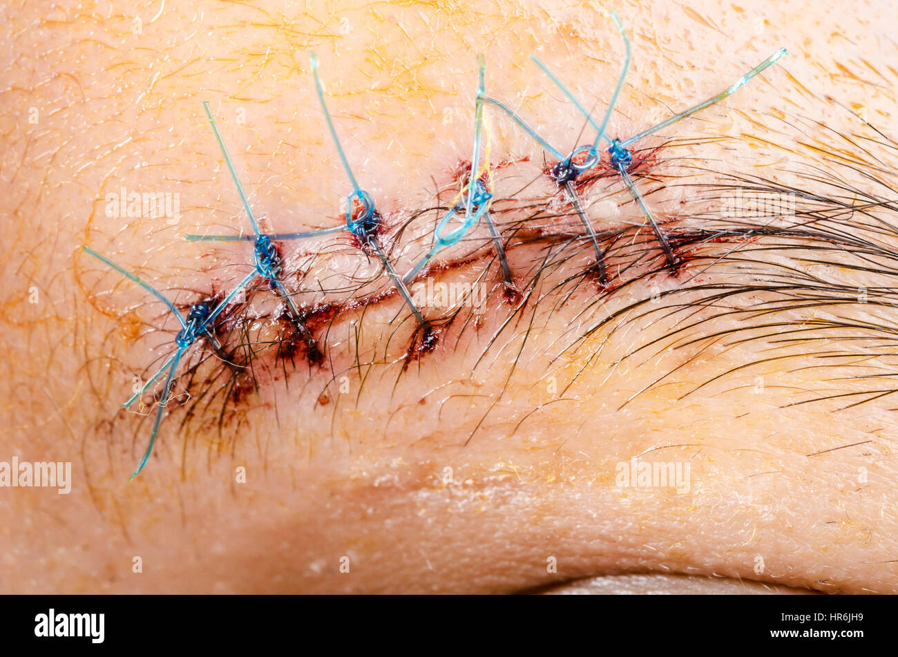 scar form stitched up skin after an operation with a blue fiber at eyebrow area Stock Photo