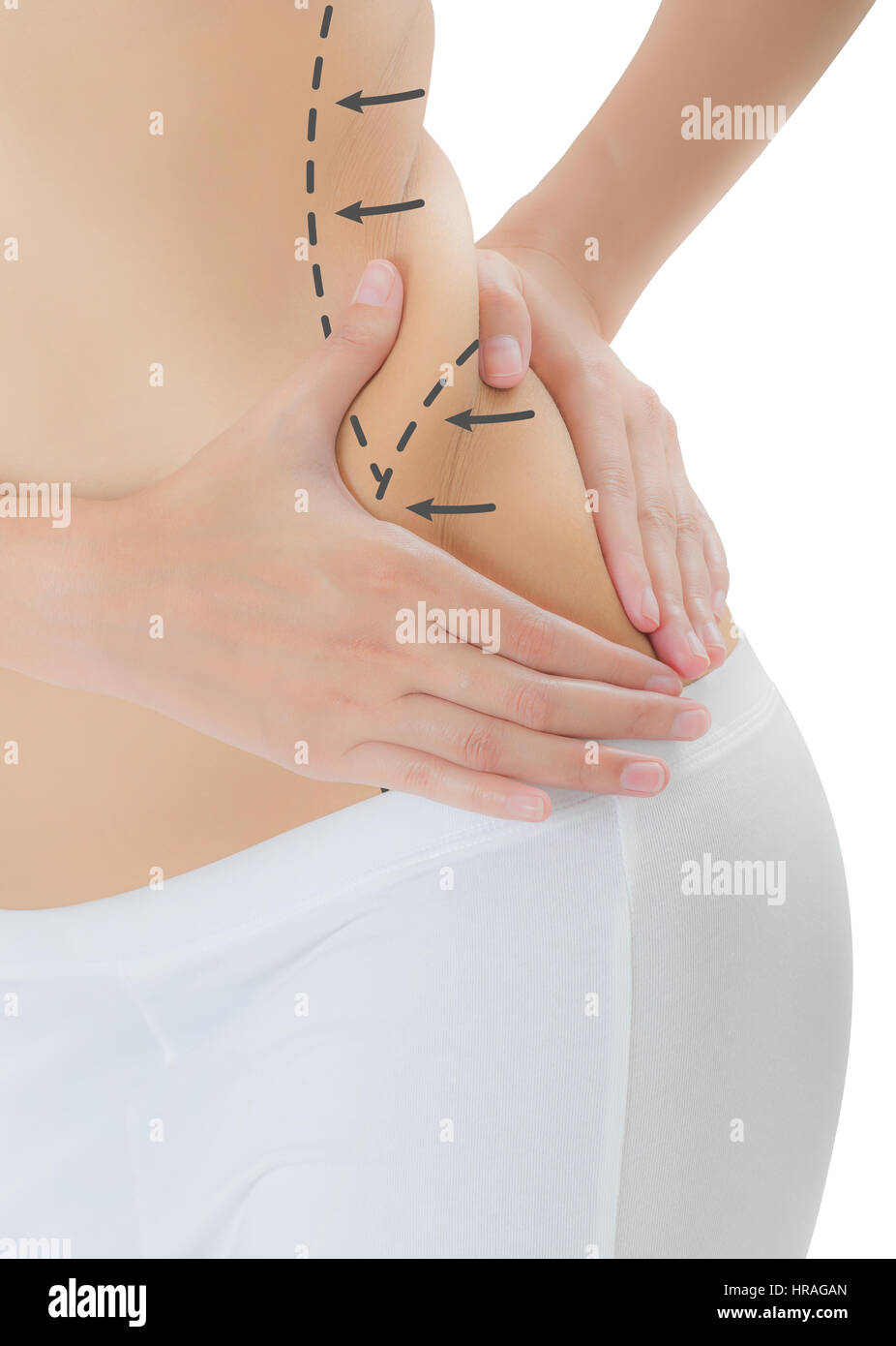 Woman grabbing skin on her flanks with the black color crosses marking,  Lose weight and liposuction cellulite removal concept, Isolated on white  backg Stock Photo - Alamy