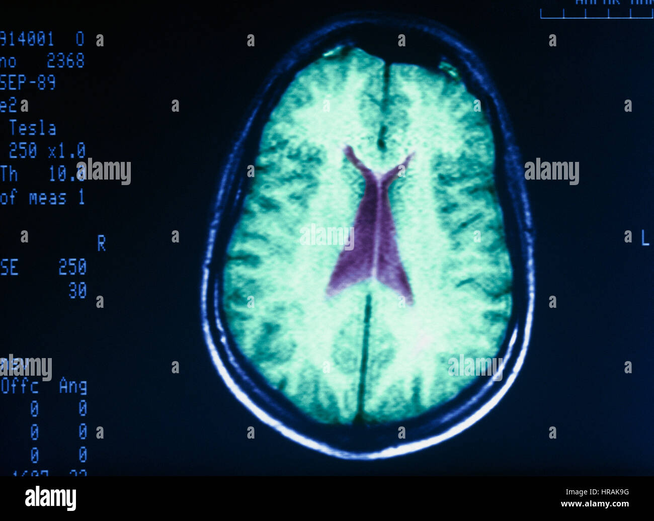 MRI image of a Human Brain Stock Photo - Alamy