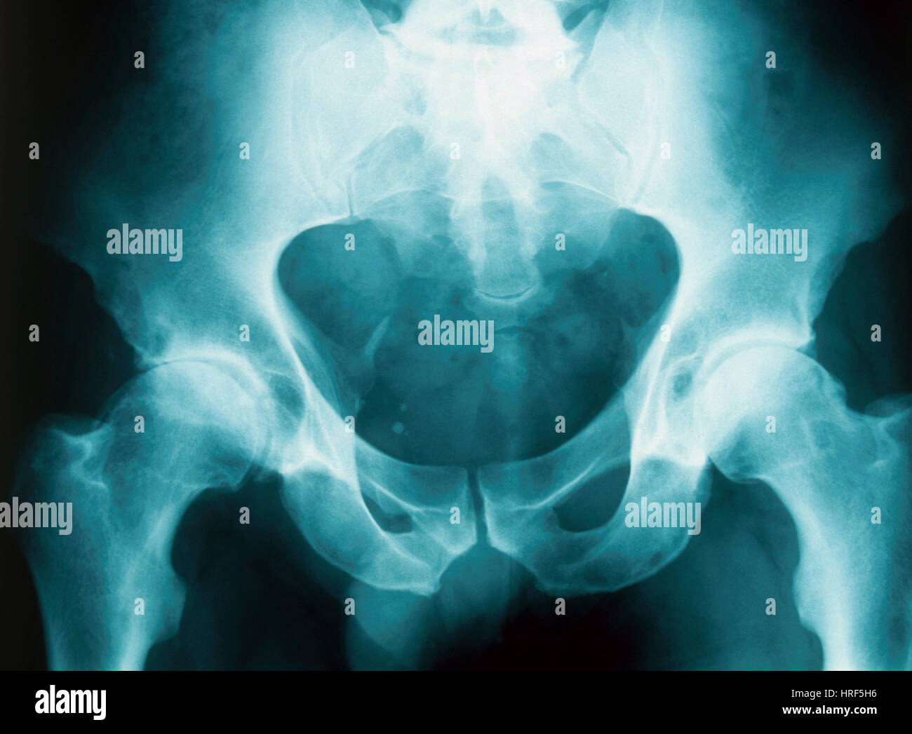 Osteoarthritis in Both Hips, X-ray Stock Photo