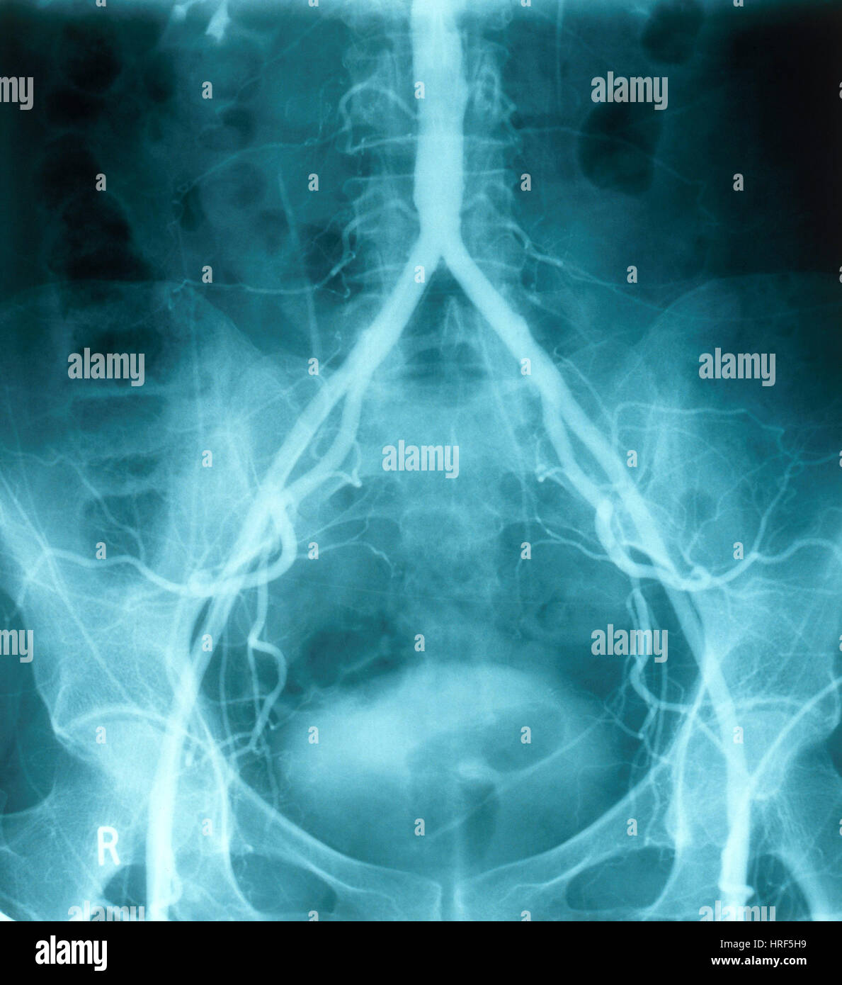 Normal Arteriogram Stock Photo