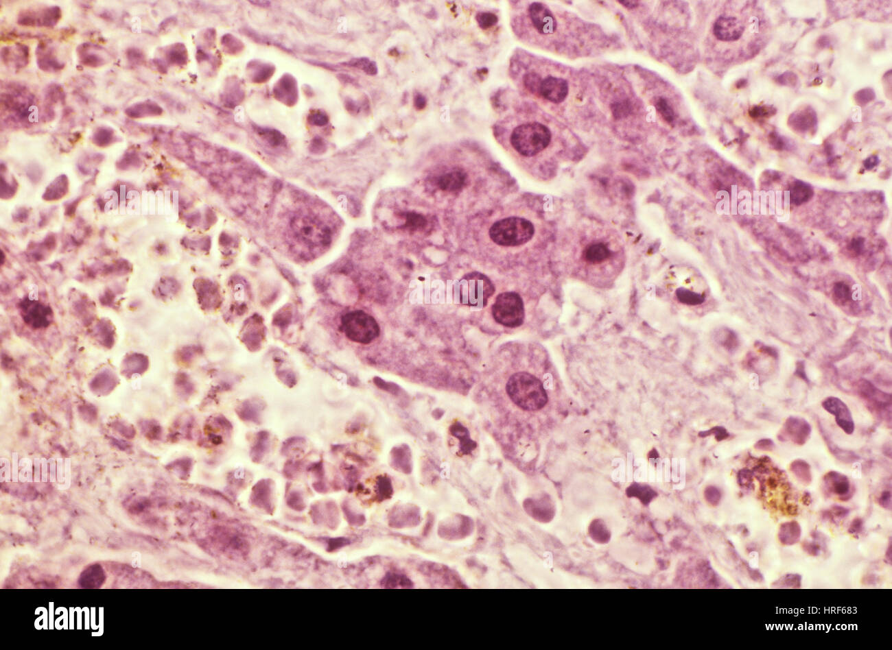 Squamous cell carcinoma of the lung hi-res stock photography and images ...