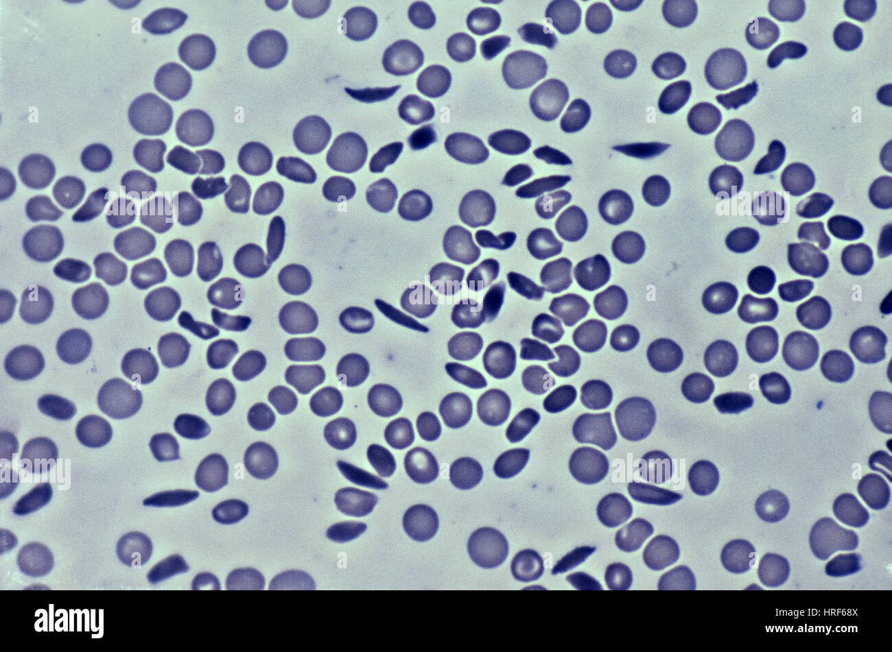 Sickle Cell Anemia Stock Photo