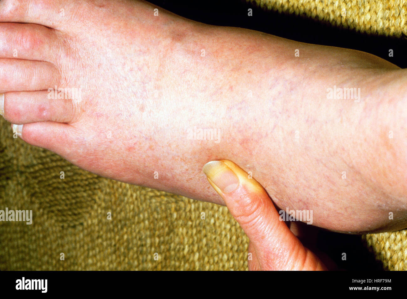 Oedema feet hires stock photography and images Alamy