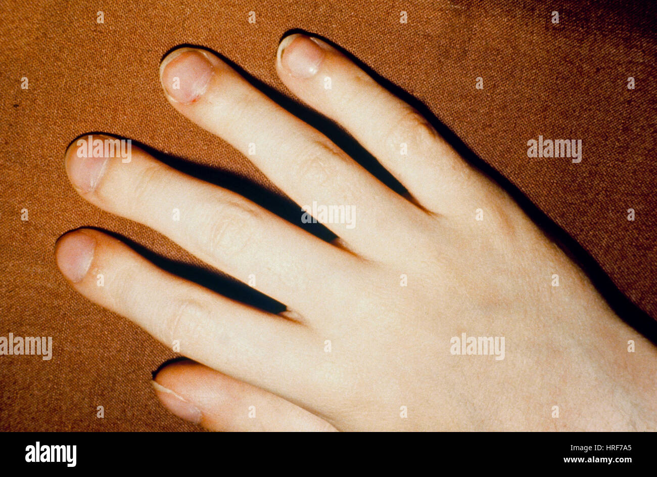 Finger Clubbing Stock Photo Alamy Finger Clubbing Stock Photo Alamy