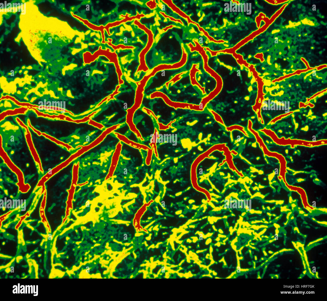 Lyme Disease, SEM Stock Photo Alamy