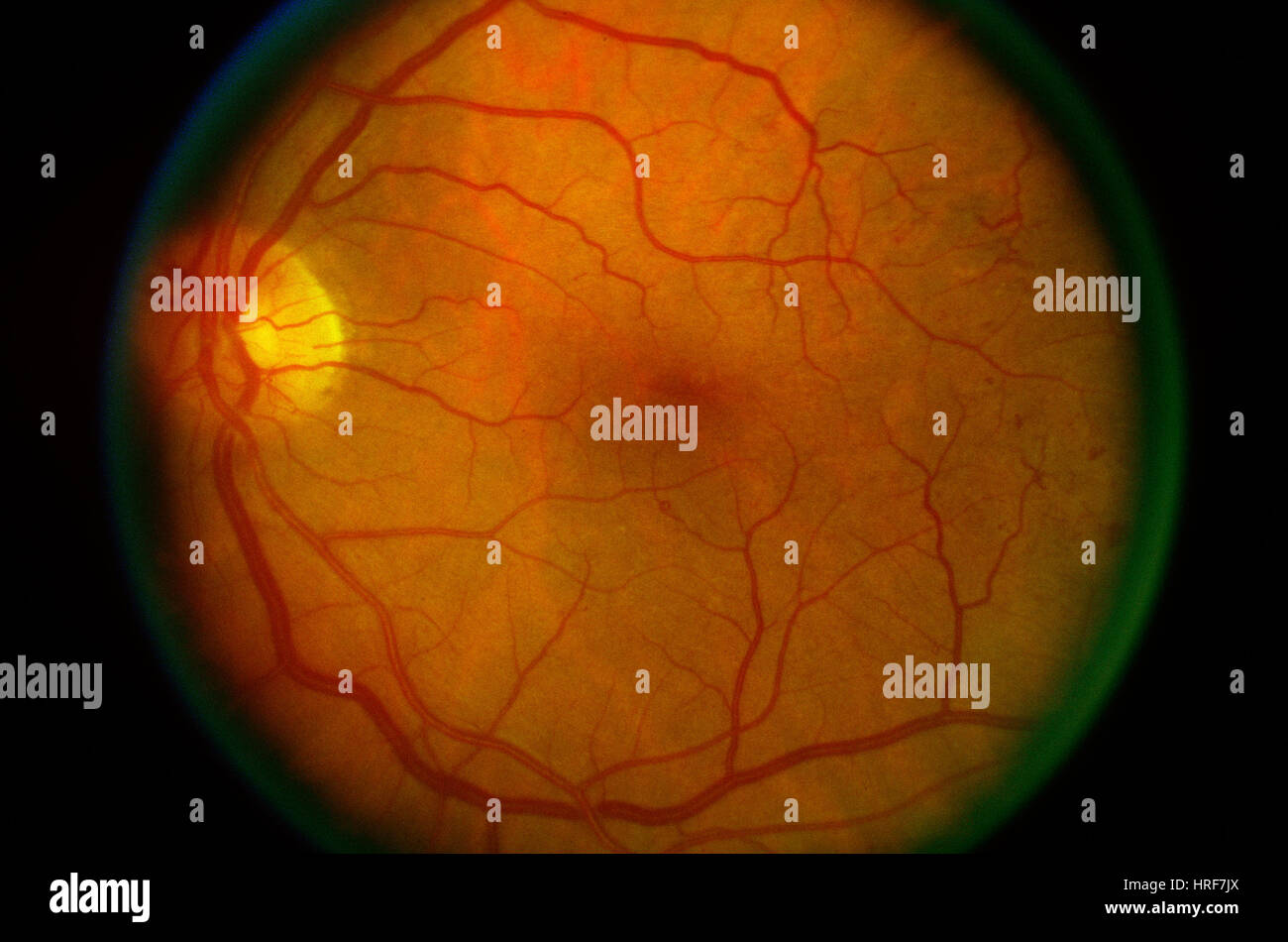 Diabetic Retinopathy Stock Photo