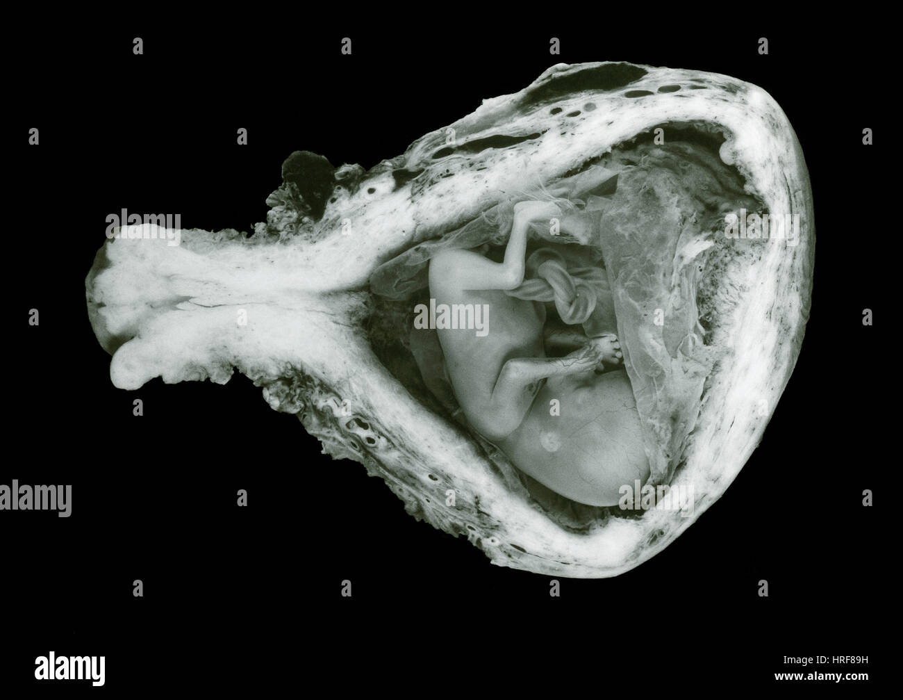 13 week old human fetus Stock Photo