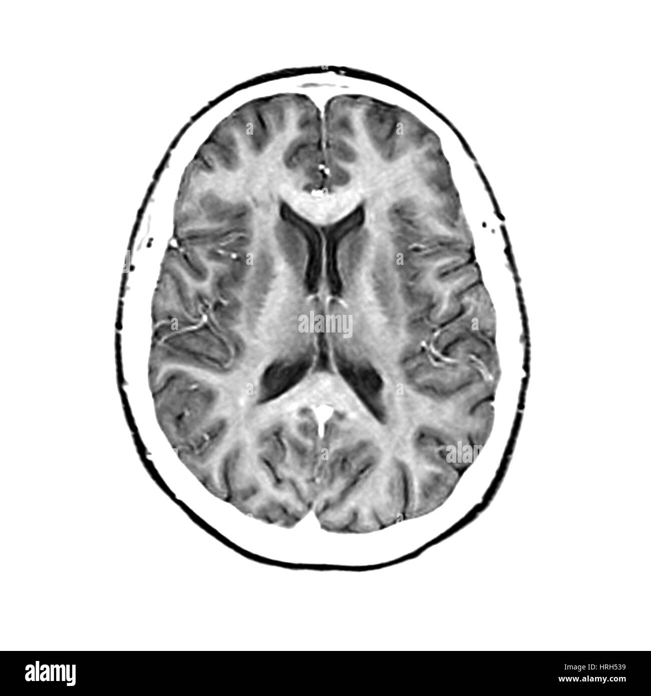 Normal Cross Sectional MRI of the Brain Stock Photo