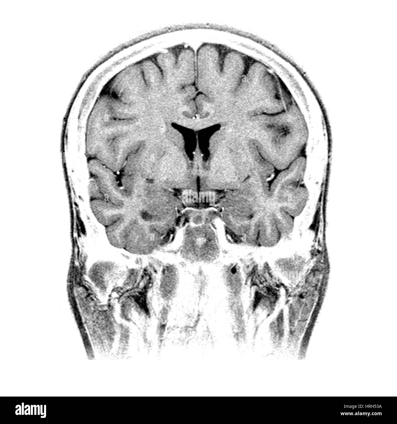 Normal Coronal MRI of the Brain Stock Photo