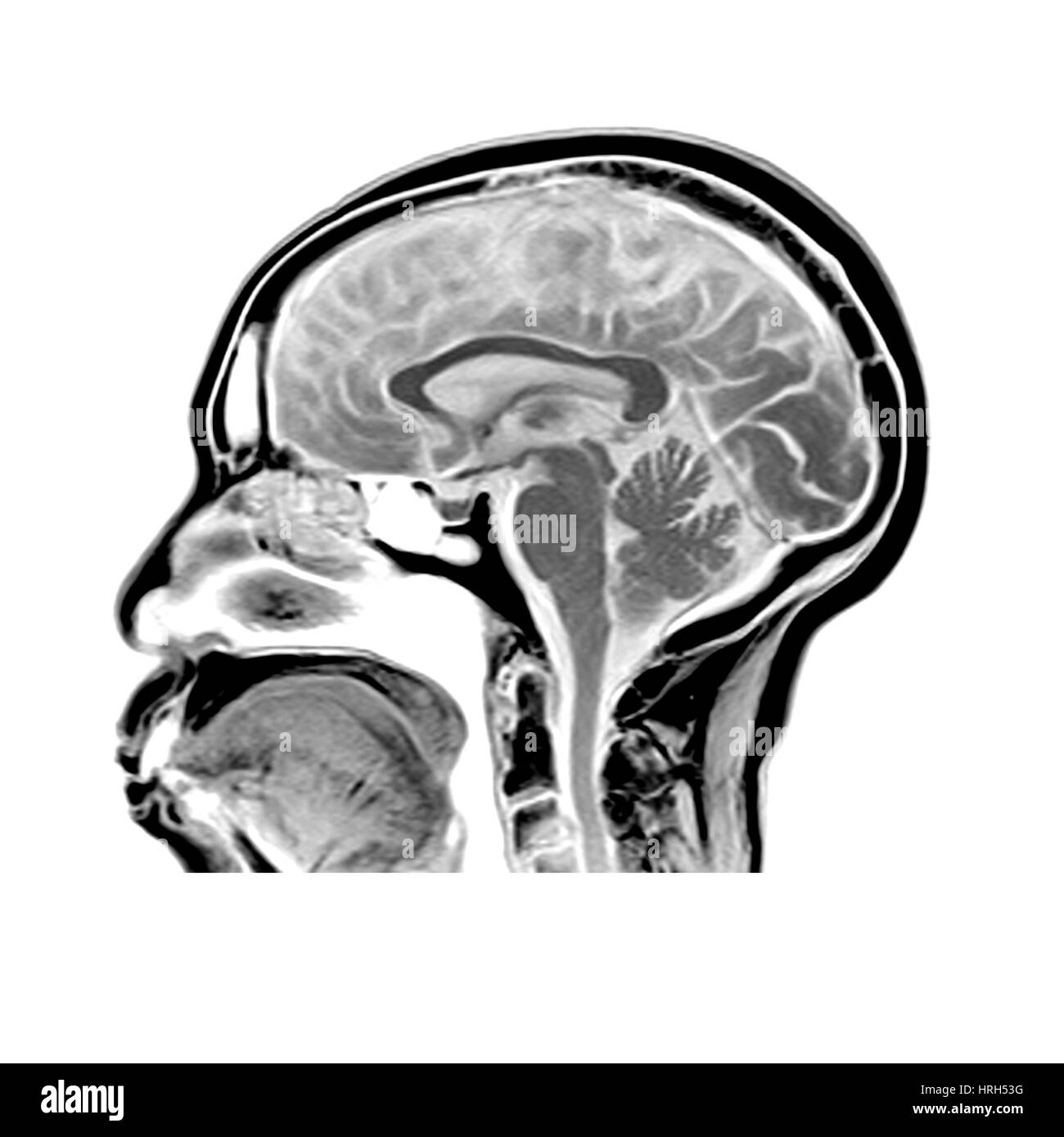 Sagittal MRI of the Brain Stock Photo
