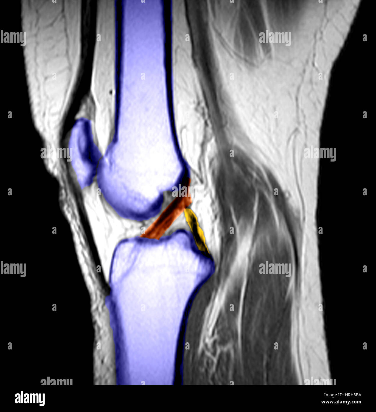 Normal mri knee hi-res stock photography and images - Alamy