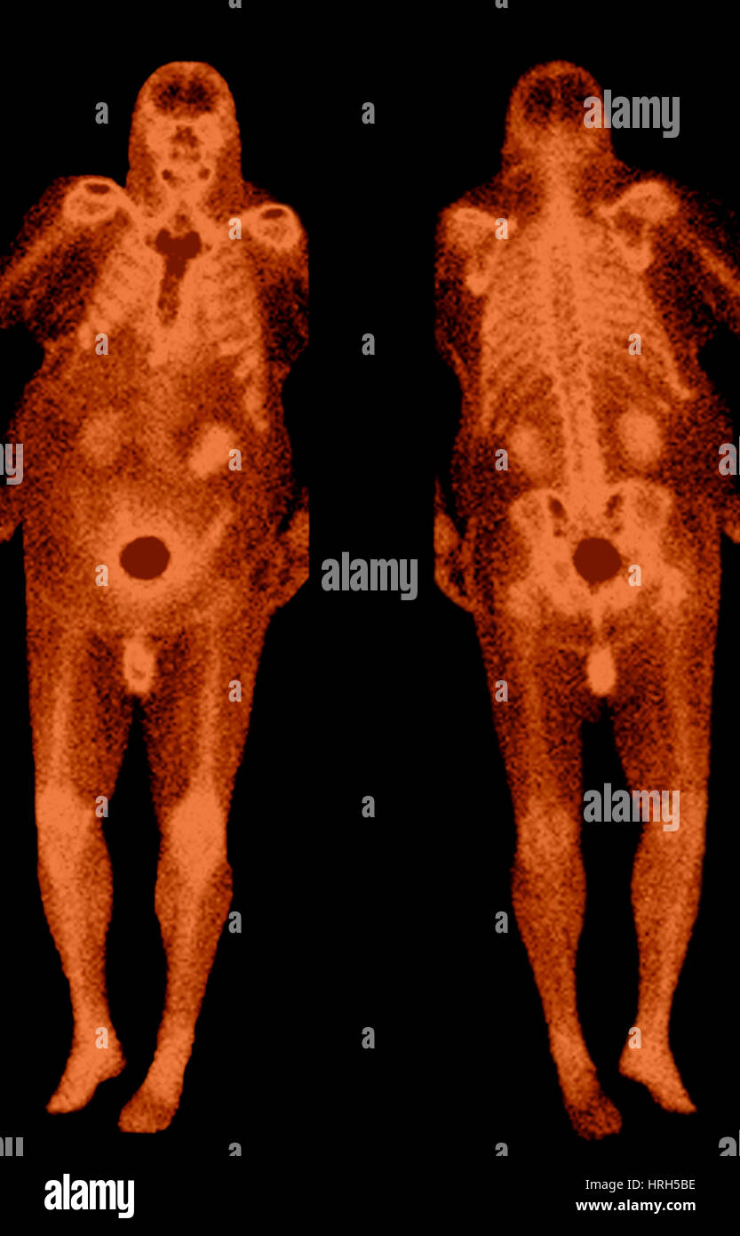 Abnormal bone scans hi-res stock photography and images - Alamy
