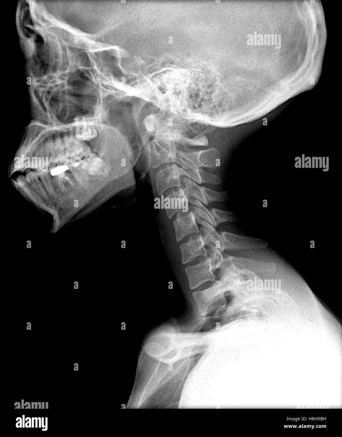 Normal neck x ray hi-res stock photography and images - Alamy