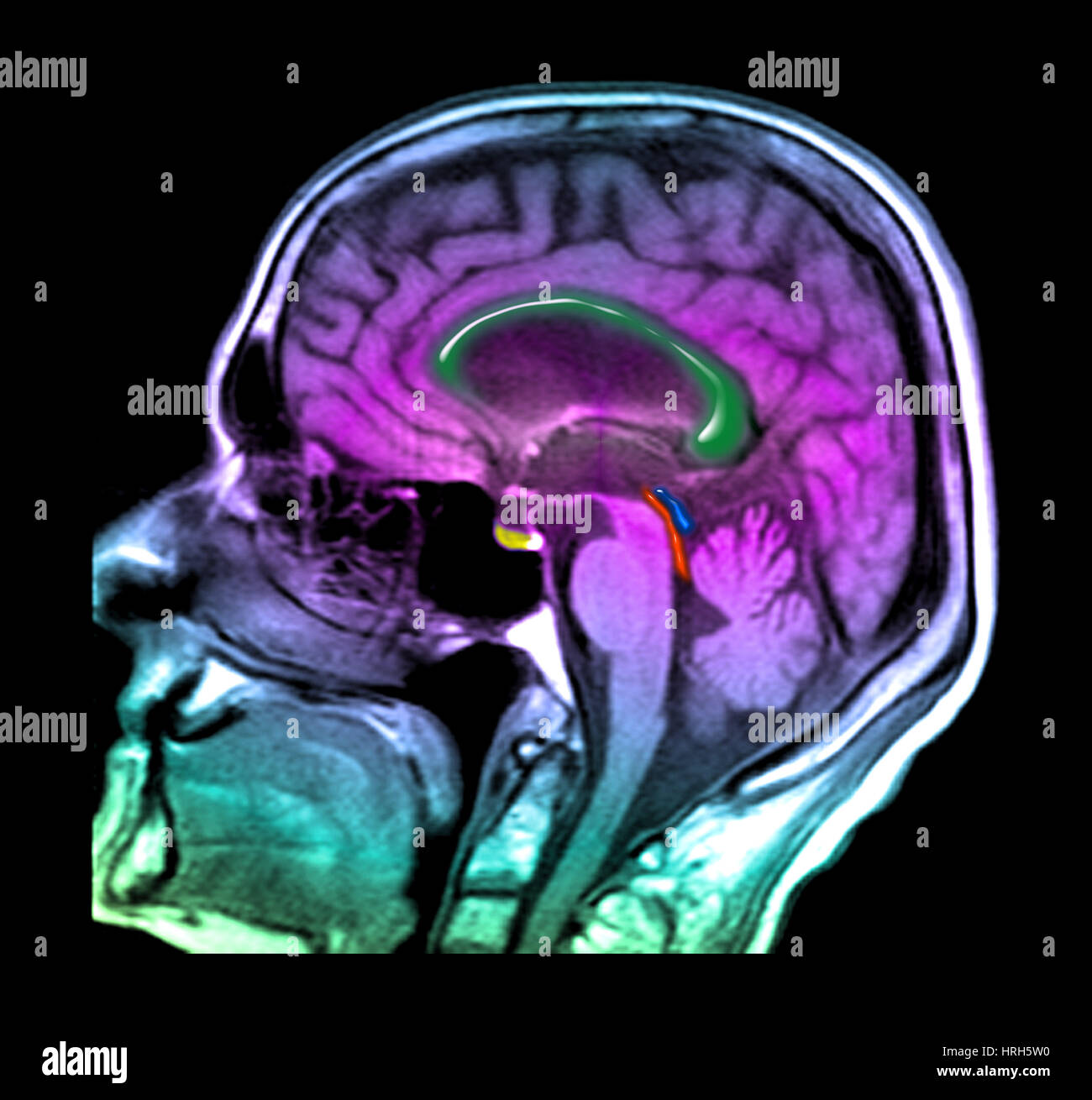 Normal pressure hydrocephalus stock photo alamy