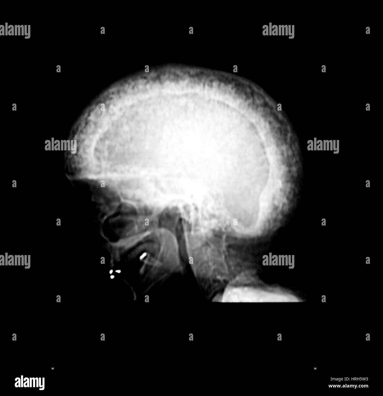 Pagets disease hires stock photography and images Alamy