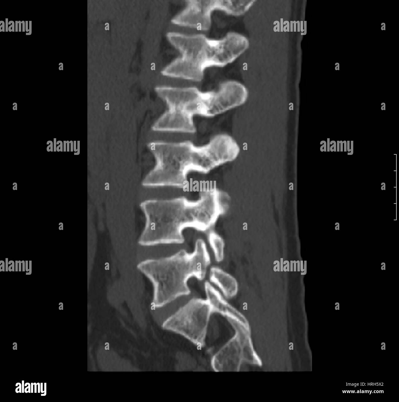 Spondylolysis Stock Photo