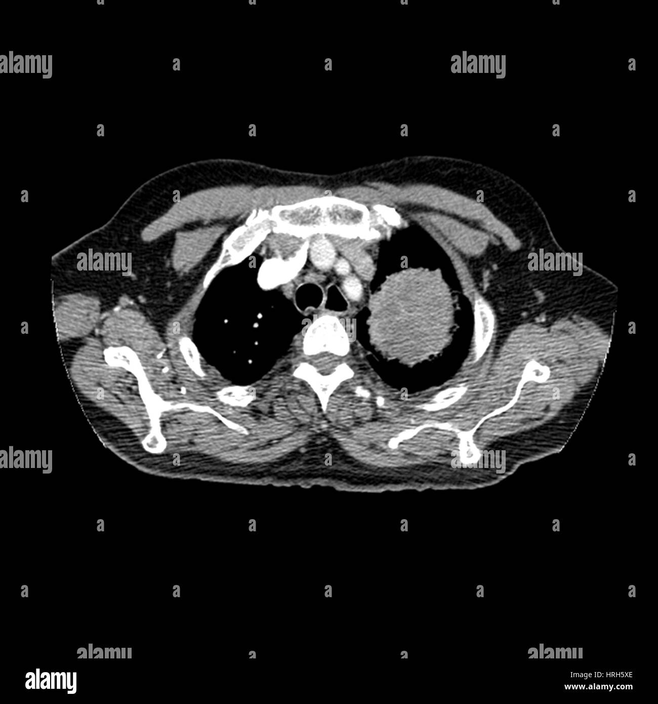 Lung Cancer Stock Photo