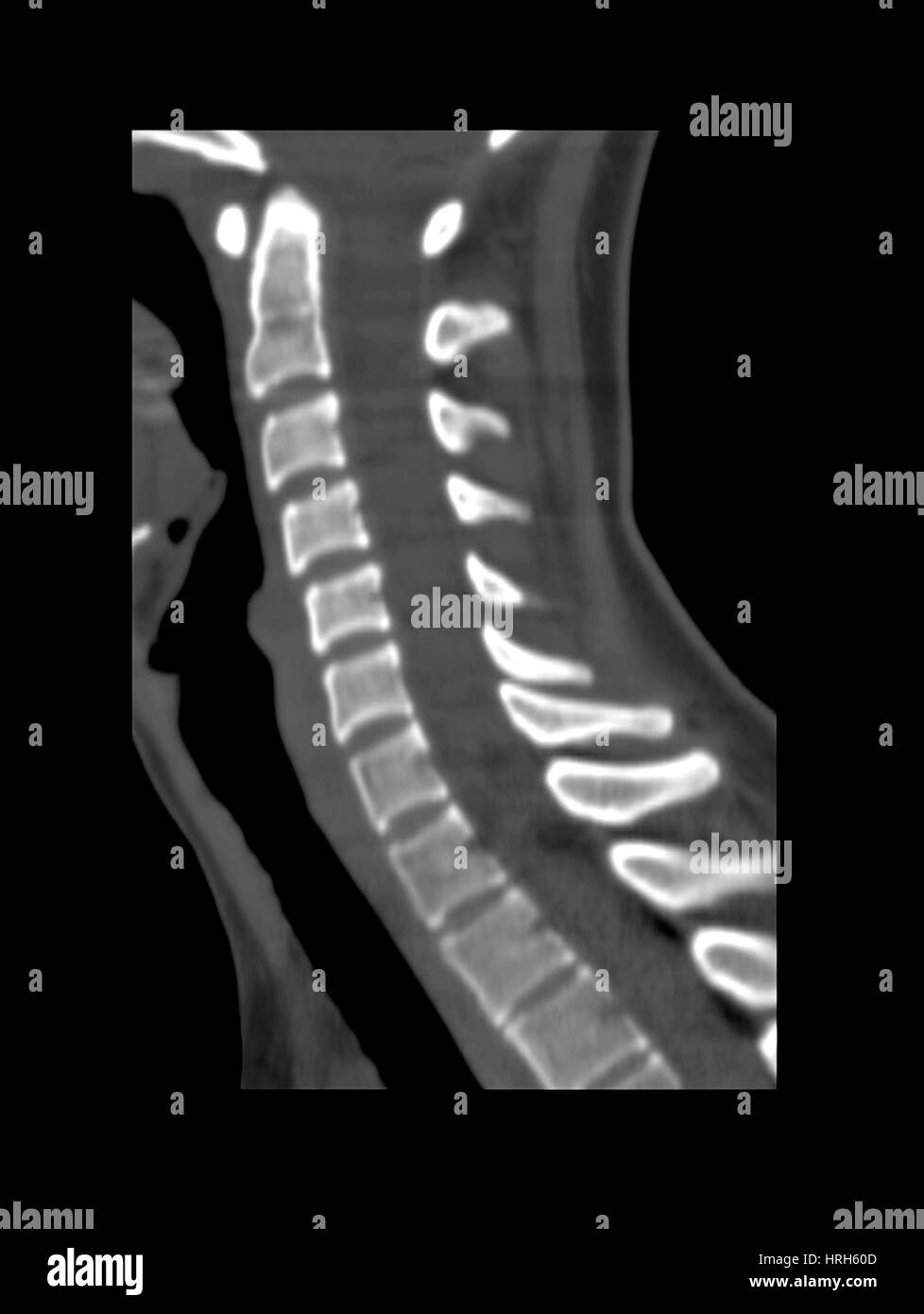 Normal Cervical Spine Stock Photo