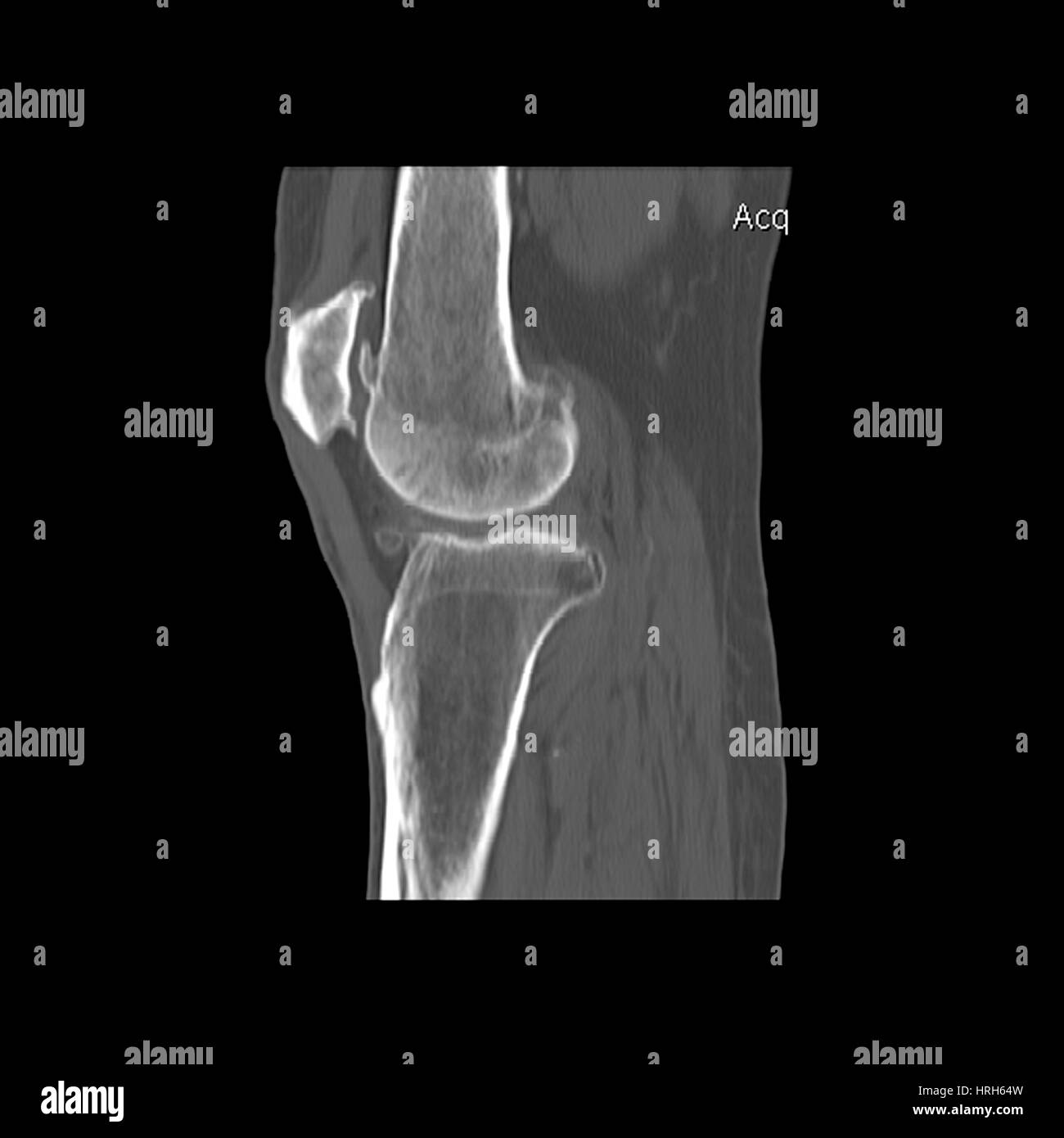 Abnormal bone scan hi-res stock photography and images - Alamy