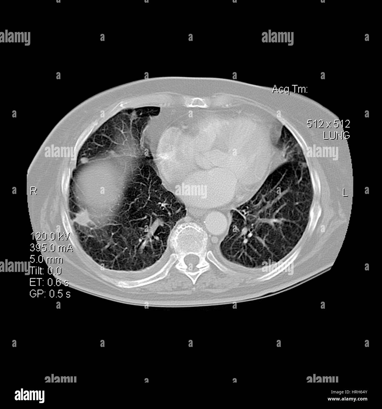 Metastatic Disease of the Lungs Stock Photo
