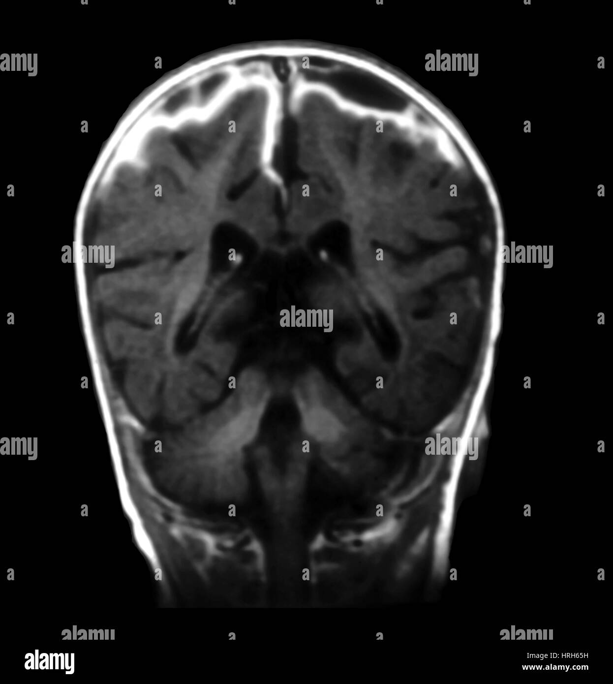 Mri of hemophilus influenza meningitis Black and White Stock Photos ...