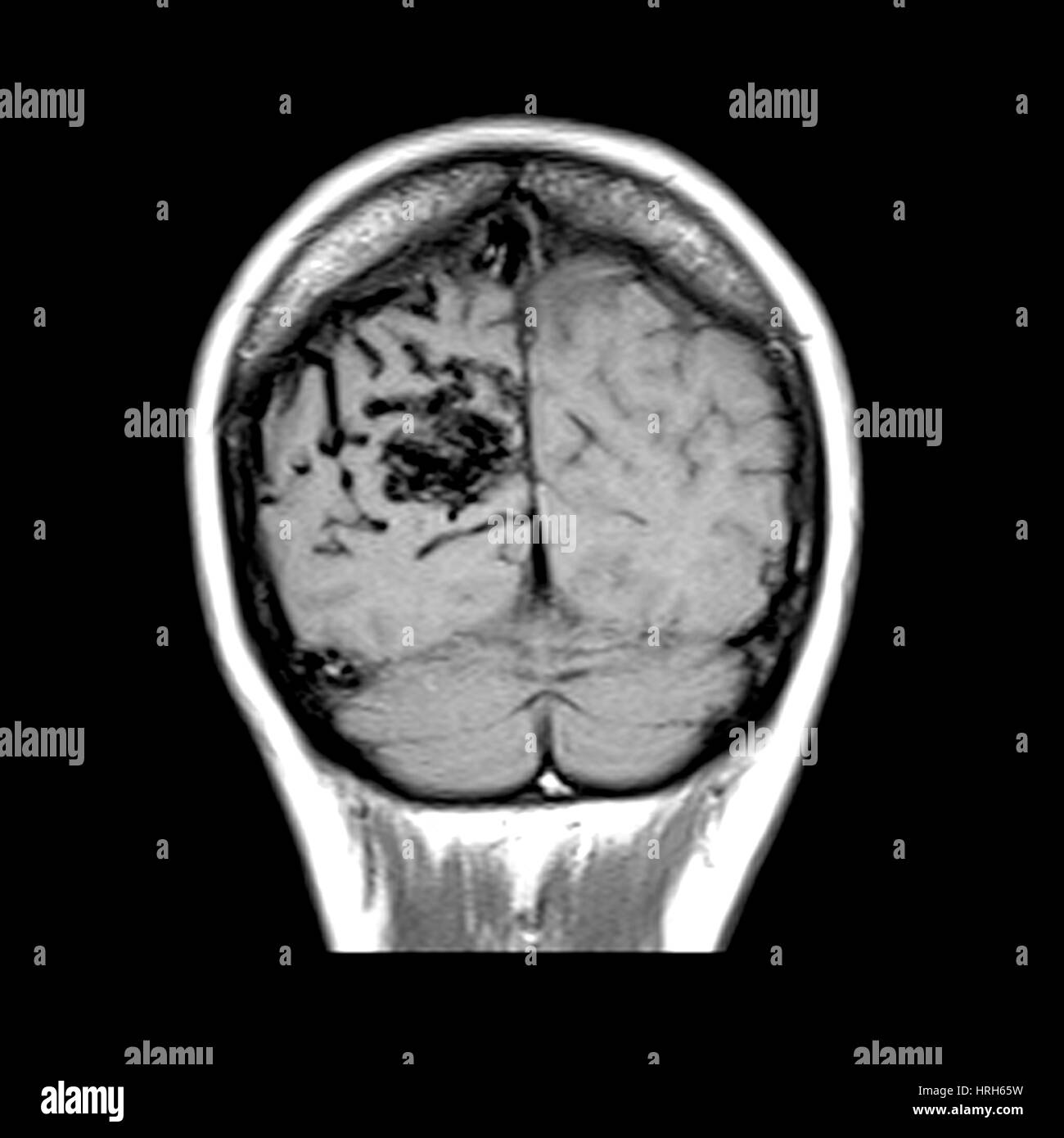MRI of Arterial Venous Malformation Stock Photo Alamy