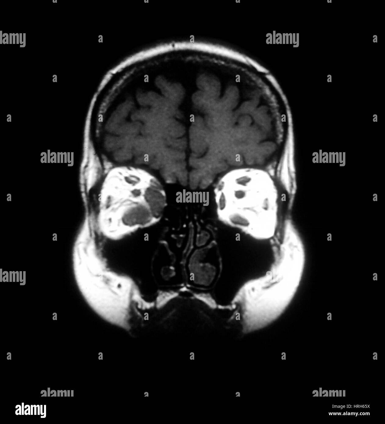 MRI of Graves Disease Stock Photo - Alamy