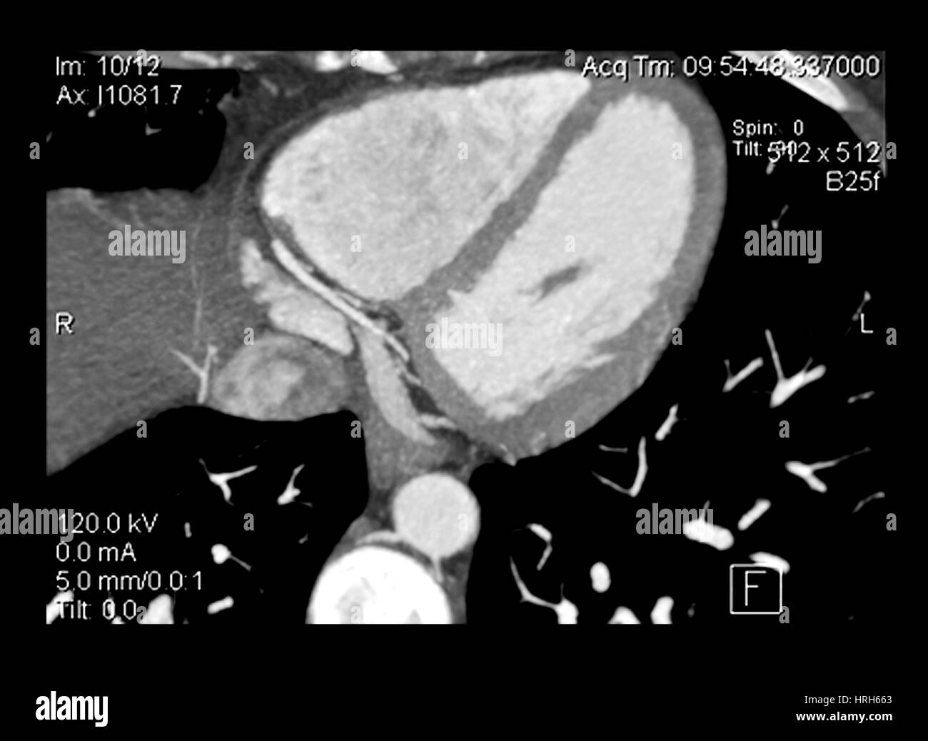 Cardiac CT Angiography Stock Photo