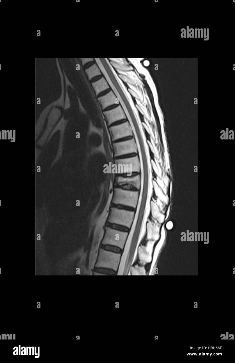 Spinal compression Black and White Stock Photos & Images Alamy