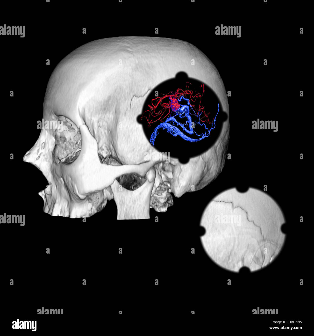 3d angiography of cerebral avm hi-res stock photography and images - Alamy