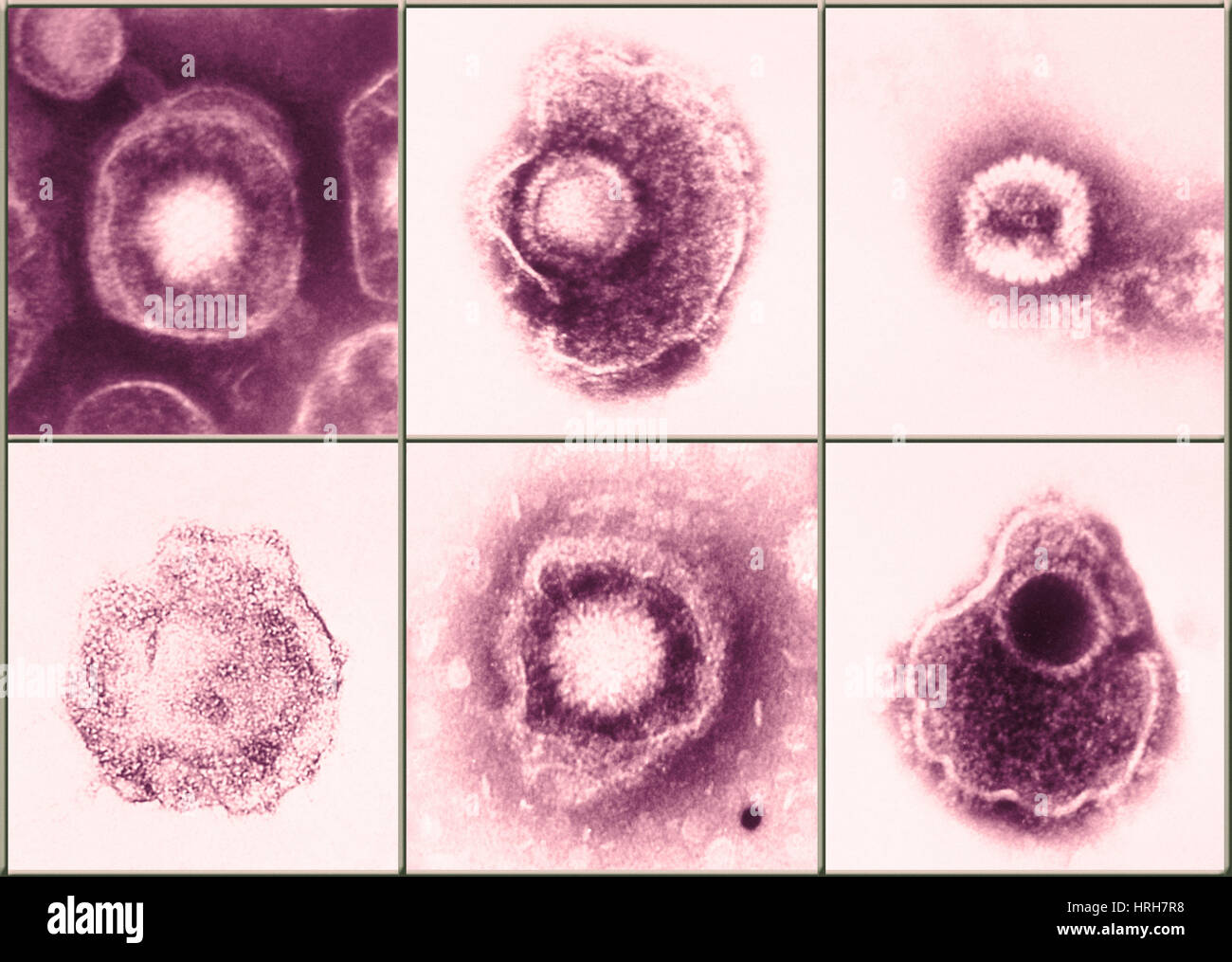 Various forms of herpes simplex virus Stock Photo - Alamy