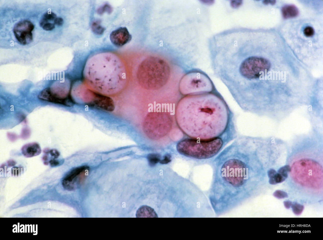 Pap Smear High Resolution Stock Photography and Images Alamy Pap Smear High Resolution Stock Photography and Images Alamy