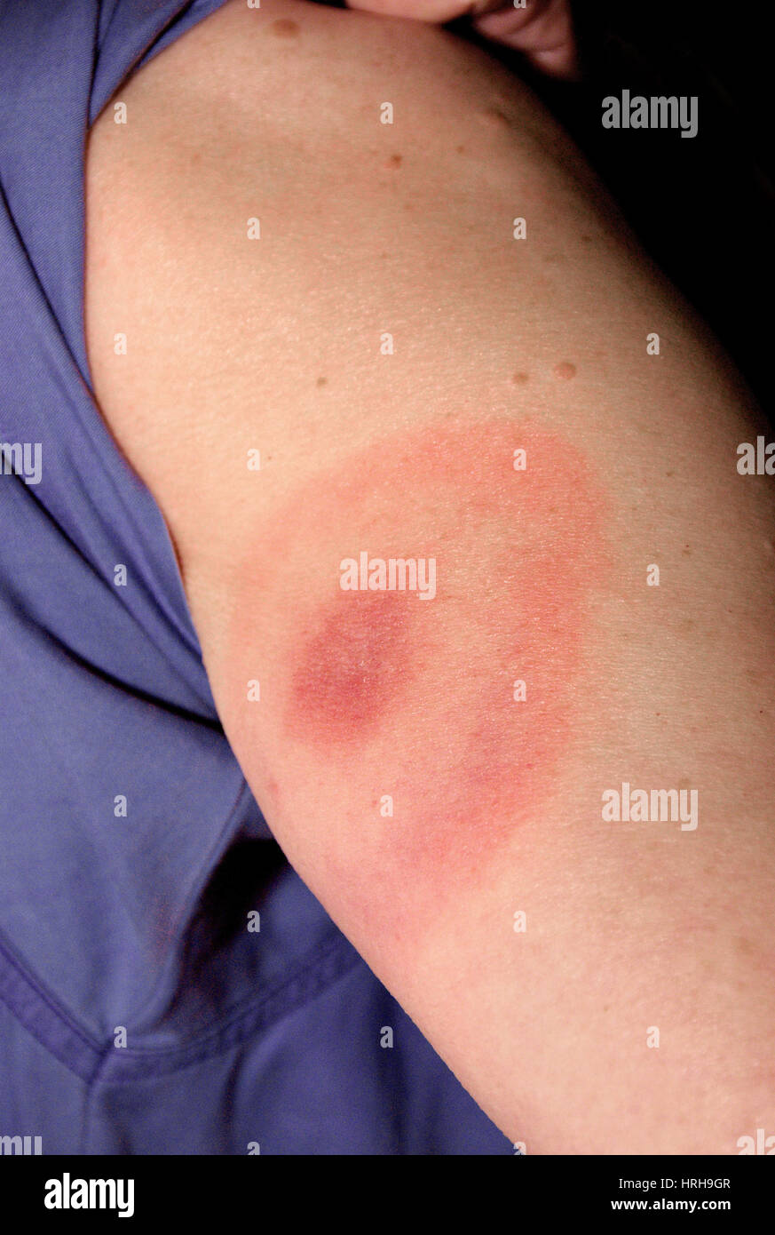 Lyme Disease Bullseye Stock Photo - Alamy