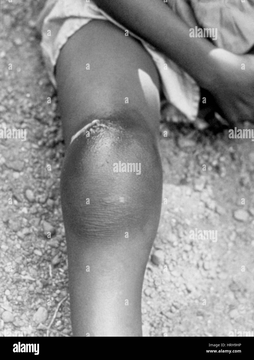 Guinea Worm Infection Stock Photo