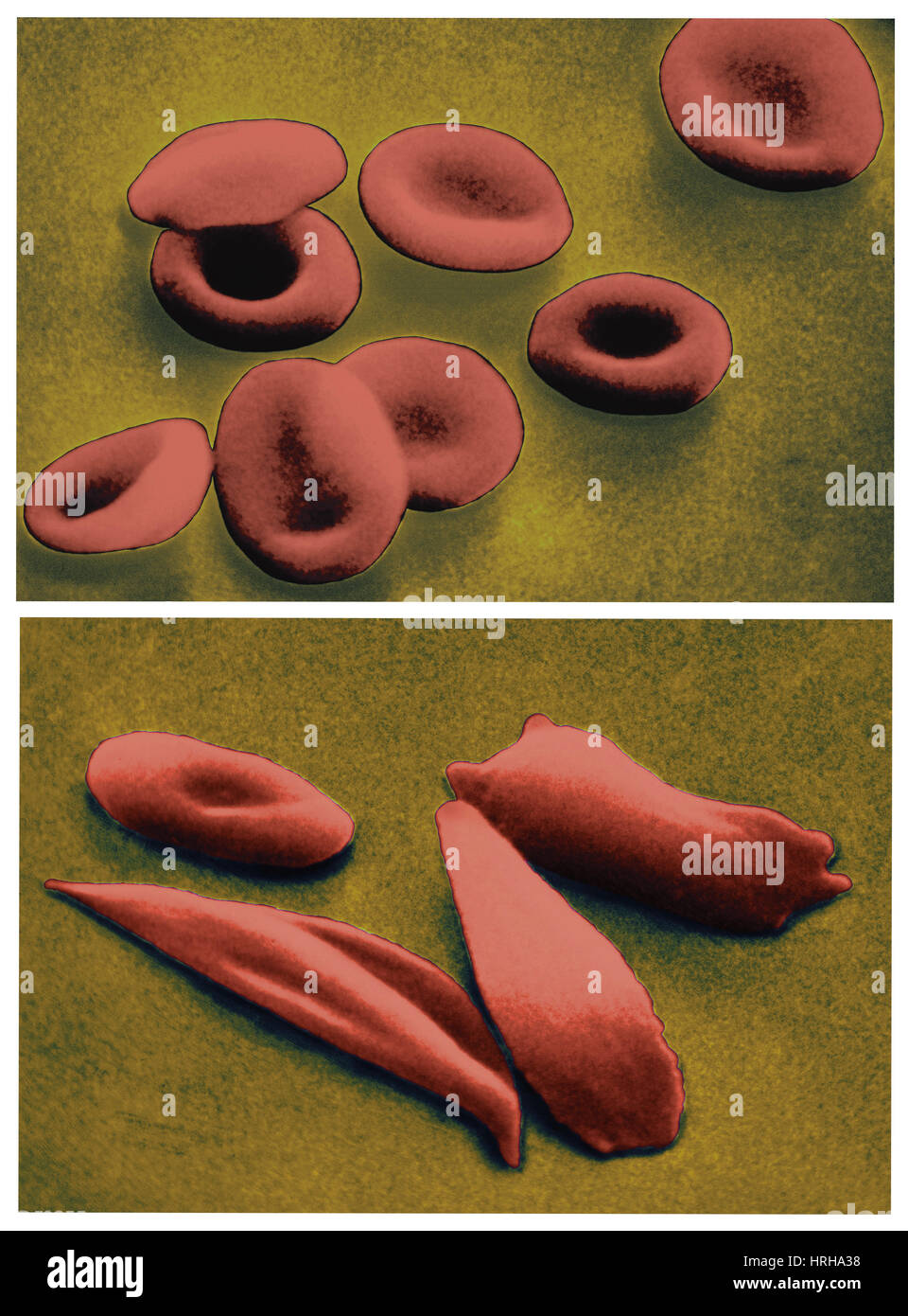 Normal and Sickle Red Blood Cells Stock Photo Alamy