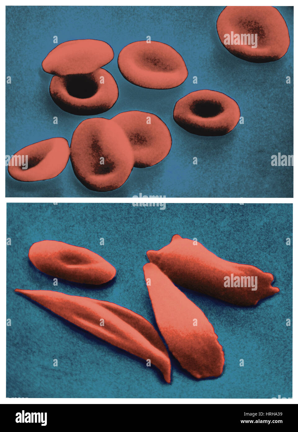 sickle cell vs normal cell