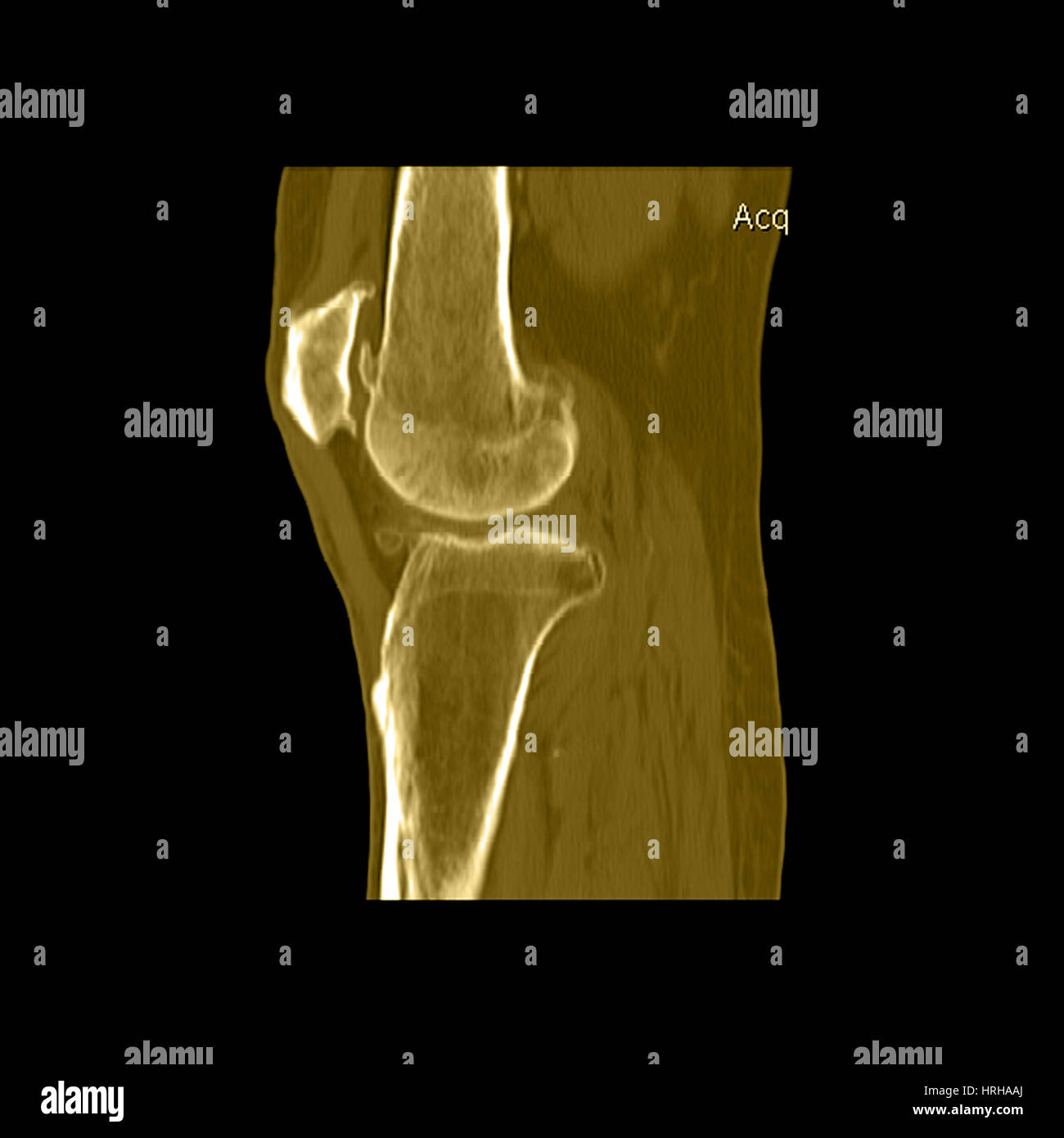 Ct scan image leg hi-res stock photography and images - Alamy