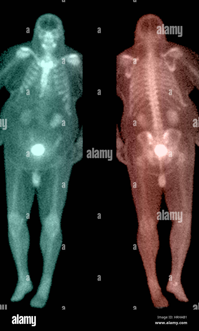 Bone Scan Stock Photo