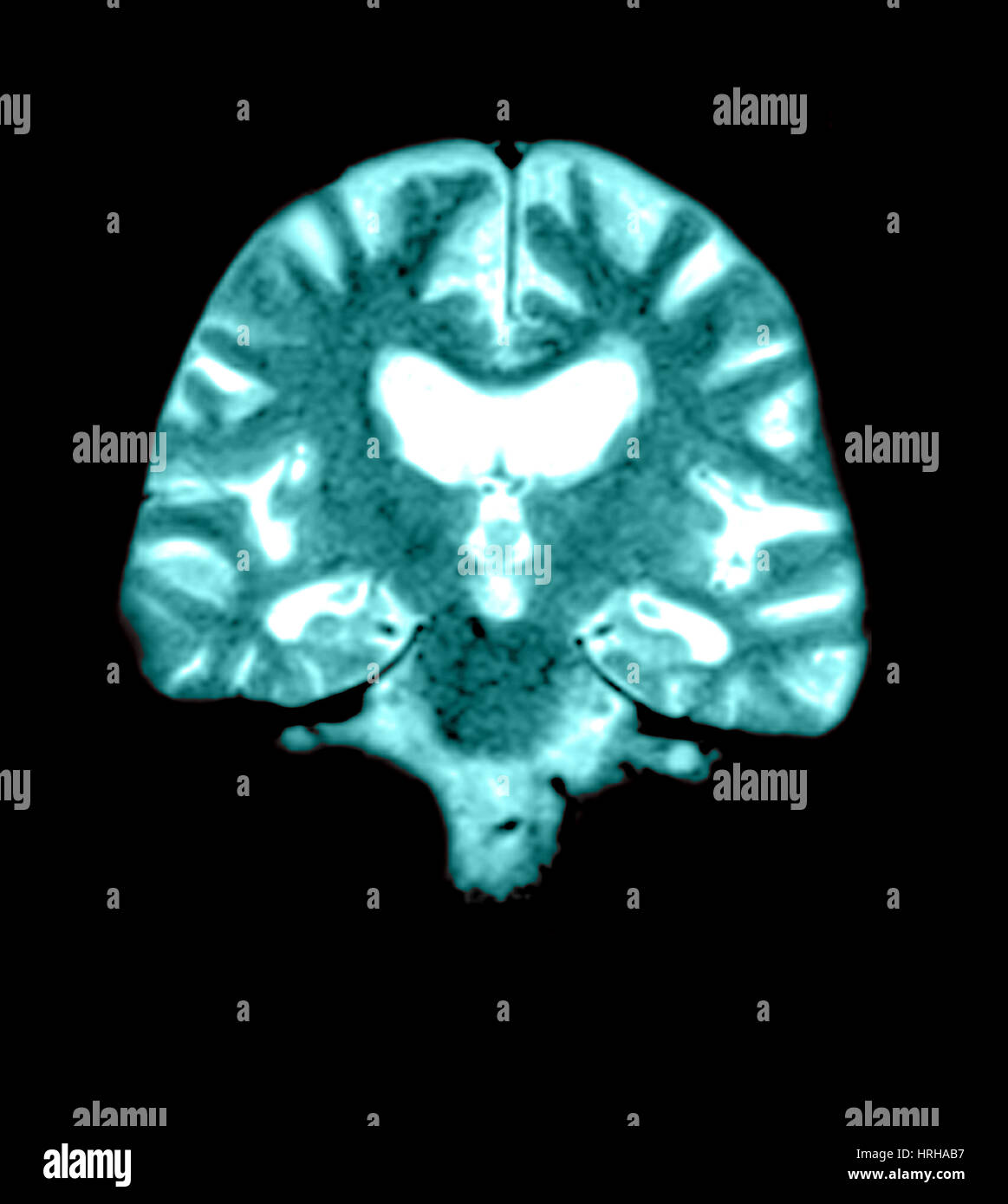 Alzheimers brain scans hi-res stock photography and images - Alamy