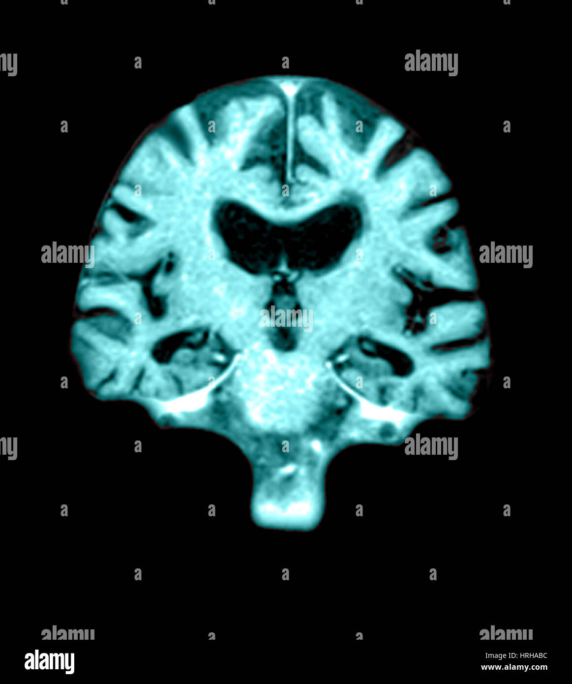 MRI of Brain With Alzheimer's Disease Stock Photo - Alamy